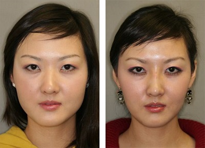 botox treatment in guam